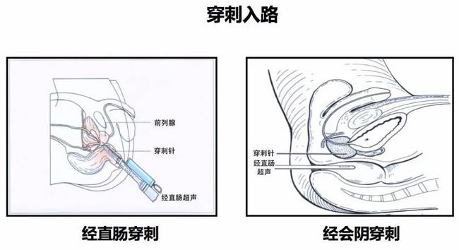 蕪湖市中醫(yī)醫(yī)院首次開(kāi)展超聲引導(dǎo)下經(jīng)會(huì)陰前列腺穿刺(圖1)