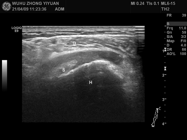 【新技術(shù)】我院功能1科開展肌骨超聲新技術(shù)(圖2)