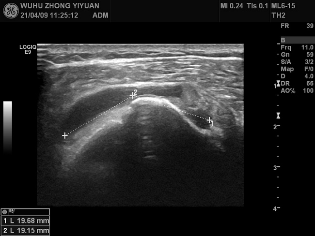 【新技術(shù)】我院功能1科開展肌骨超聲新技術(shù)(圖3)