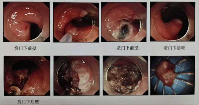 炎夏漸至，“胃腸”已碌 ——狹小的空間見(jiàn)證消化內(nèi)鏡微創(chuàng)手術(shù)的魅力(圖2)