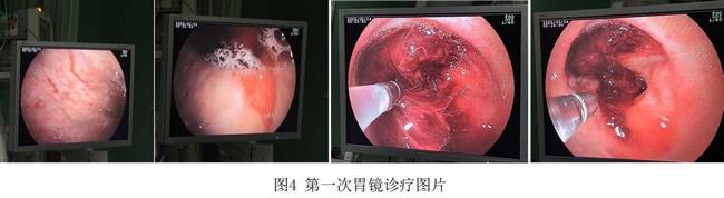 癡呆老人命懸一線，內(nèi)鏡止血彰顯奇功(圖2)