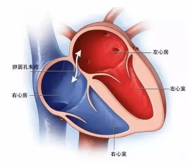 探尋不明原因卒中、偏頭痛根源的檢查技術(shù)—TCD發(fā)泡試驗(yàn)(圖1)