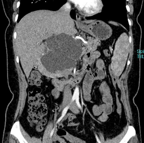 首例腹腔鏡胰十二指腸切除患者痊愈出院(圖1)