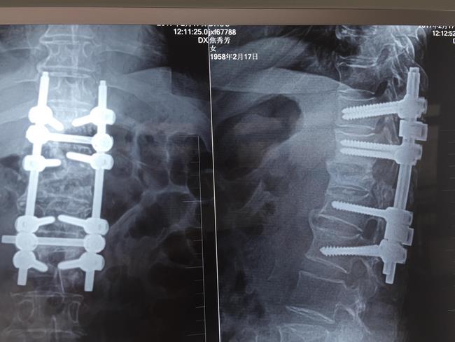 我院骨四科成功開展一例脊柱陳舊性骨折角狀后凸矯形手術(圖3)