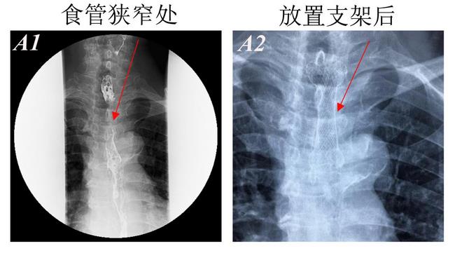 消化科運用多學科會診（MDT）微創(chuàng)診治食管惡性腫瘤侵潤所致食、氣道梗阻(圖4)