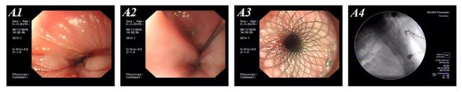 消化科運用多學科會診（MDT）微創(chuàng)診治食管惡性腫瘤侵潤所致食、氣道梗阻(圖5)