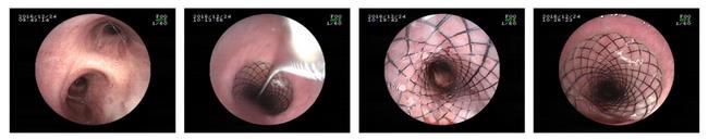 消化科運用多學科會診（MDT）微創(chuàng)診治食管惡性腫瘤侵潤所致食、氣道梗阻(圖6)