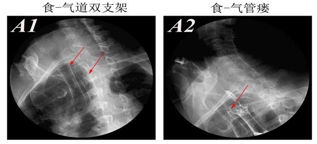 消化科運用多學科會診（MDT）微創(chuàng)診治食管惡性腫瘤侵潤所致食、氣道梗阻(圖8)