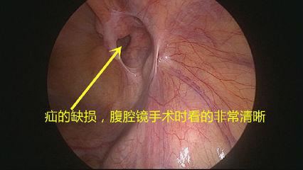 切口小，當(dāng)天即可生活自理——外三科開展腹腔鏡下疝氣手術(shù)(圖1)