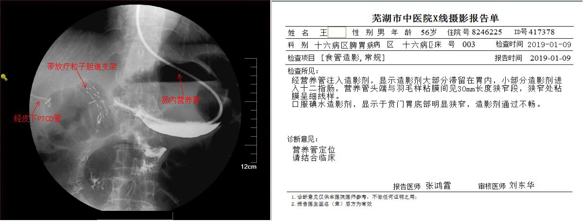 三個(gè)支架植入后——我院脾胃病1科成功為腫瘤患者施行內(nèi)鏡下高難度多支架植入術(shù)(圖2)