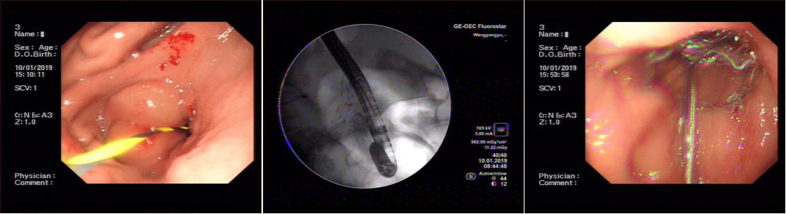 三個(gè)支架植入后——我院脾胃病1科成功為腫瘤患者施行內(nèi)鏡下高難度多支架植入術(shù)(圖3)
