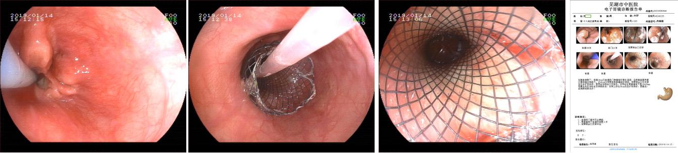 三個(gè)支架植入后——我院脾胃病1科成功為腫瘤患者施行內(nèi)鏡下高難度多支架植入術(shù)(圖5)