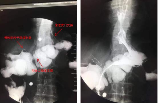 三個(gè)支架植入后——我院脾胃病1科成功為腫瘤患者施行內(nèi)鏡下高難度多支架植入術(shù)(圖6)