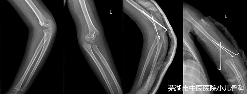 兒童健康的守護者——蕪湖市中醫(yī)醫(yī)院兒童骨科(圖2)